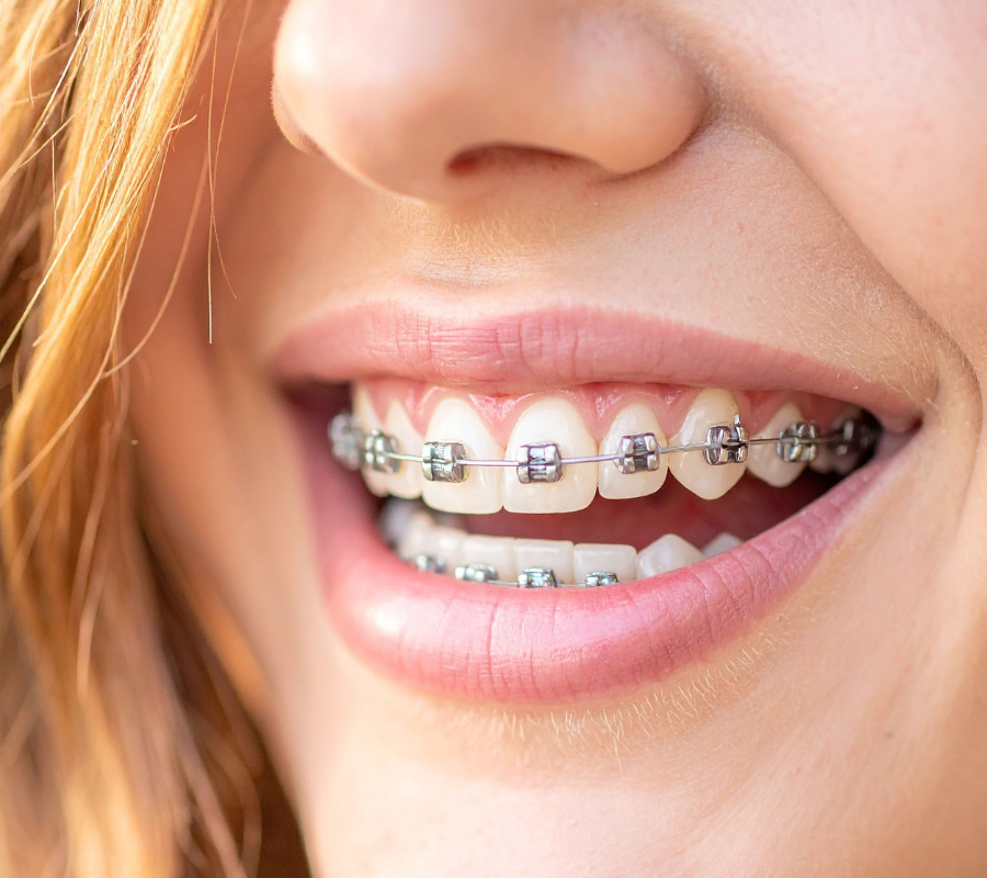 Dental Braces