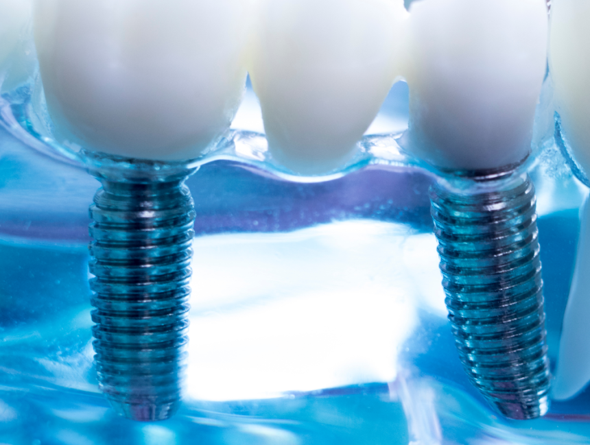 Dental Implants