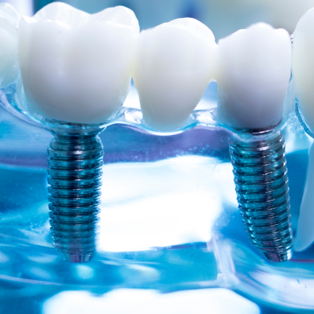Dental Implants Draft